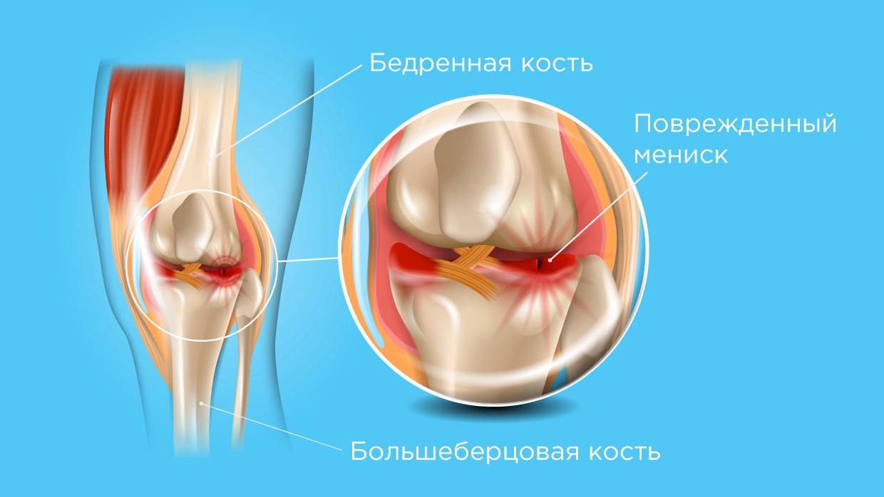 повреждение коленного сустава лечение на дому (100) фото